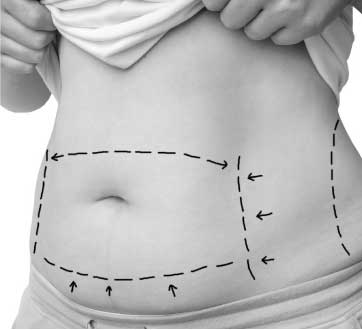cirugia abdominoplastia